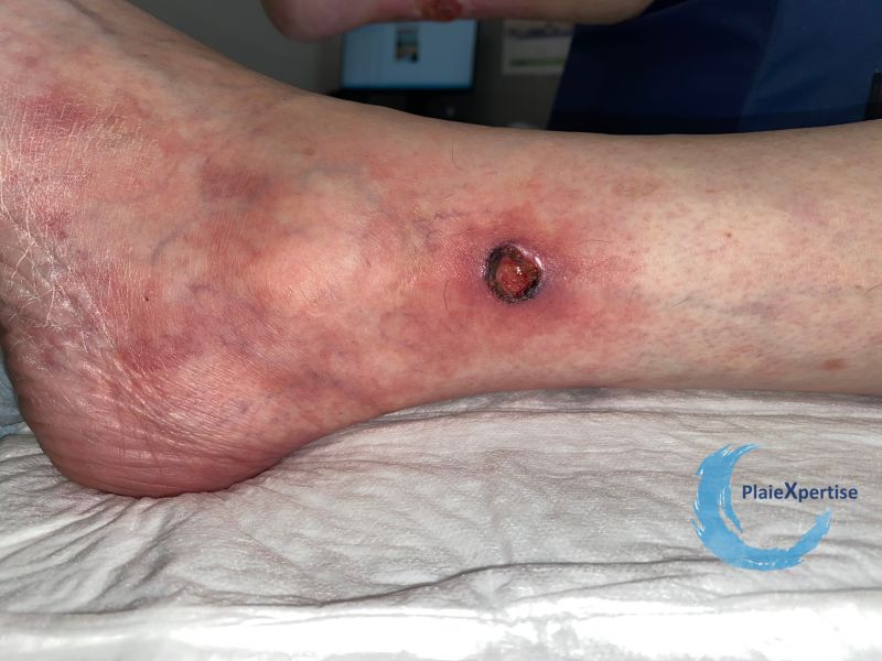 Fichier:Angiodermite typique79.jpg
