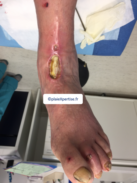 Fichier:Cou de pied9.png