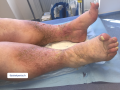 Dermiteocre27.png