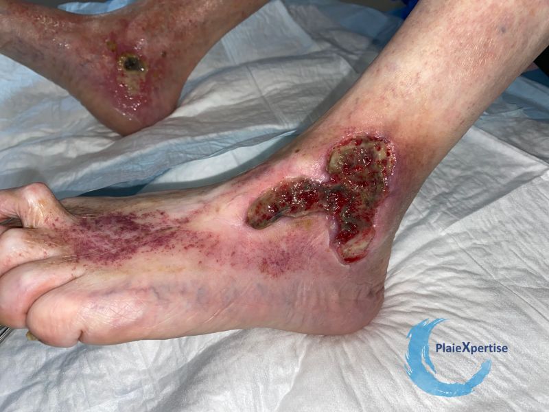 Fichier:Tissu de granulation inflammatoire42.jpg