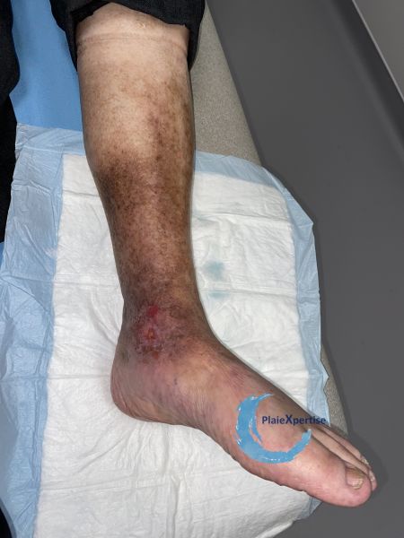 Fichier:Ulcère veineux14.jpg