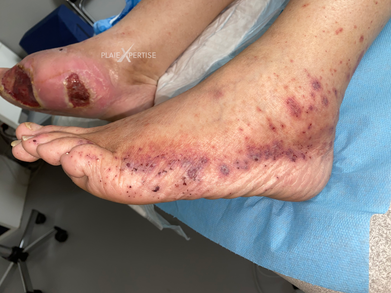 Fichier:Vascularite20.png