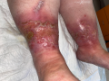 Hypodermite chronique34.png