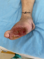 Pied de Charcot1.png