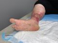 Pyoderma gangrenosum61.jpg