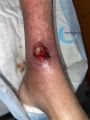 Angiodermite typique103.jpg