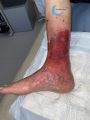 Dermite d'irritation164.jpg
