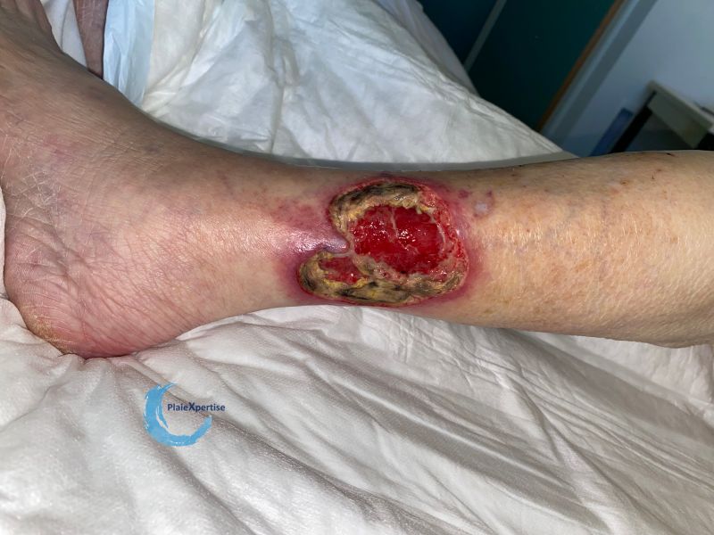 Fichier:Angiodermite typique118.jpg