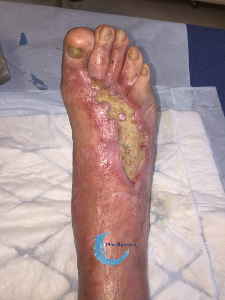 Fichier:Cou de pied53.png
