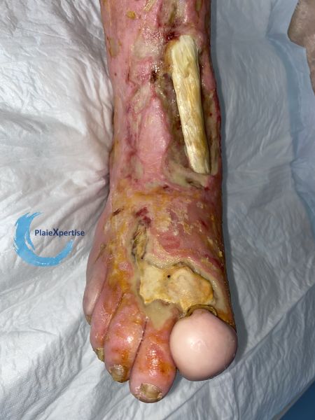 Fichier:Tendon nécrotique humide60.jpg