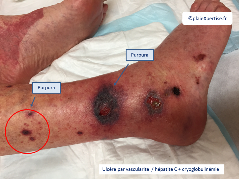 Fichier:Vascularite2.png