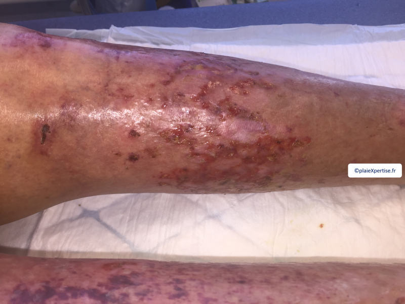 Fichier:Erosion ponctiforme moins de 5 mm6.png