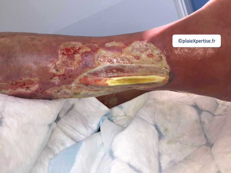 Fichier:Tendon nécrotique sec11.png