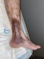 Dermiteocre95.jpg
