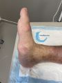 Pied de Charcot21.jpg