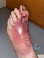Pied infecté17.jpg
