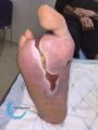 Amputation37.jpg