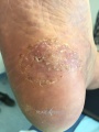 Pustules10.jpg