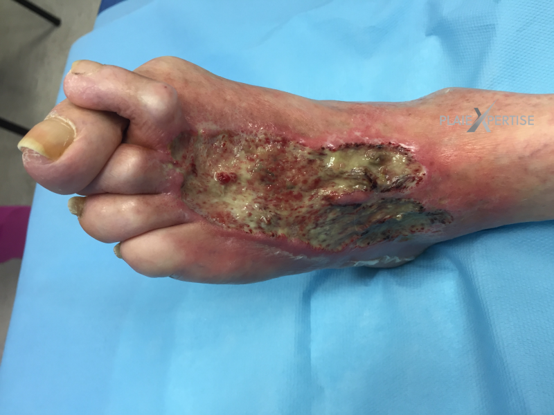 Fichier:Cou de pied31.png