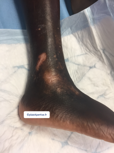 Fichier:Drépanocytose13.png