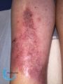 Nécrobiose lipoïdique20.jpg
