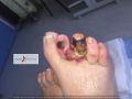 Nécrose humide Pied 4.jpg