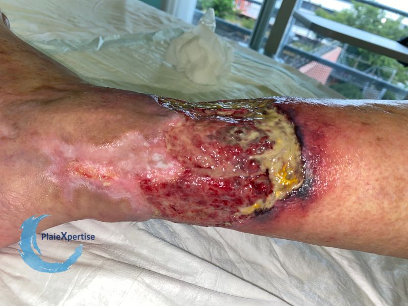 Fichier:Angiodermite typique72.jpg