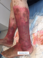 Erythrocyanose2.png