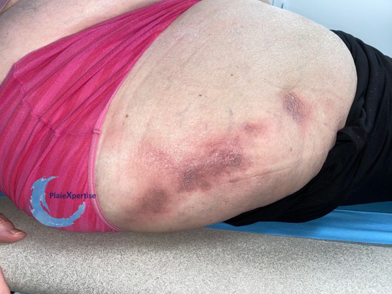 Fichier:Lipodystrophie2.jpg