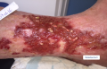 Tissu de granulation inflammatoire10.png