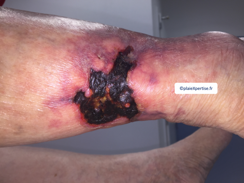 Fichier:Angiodermite typique29.png