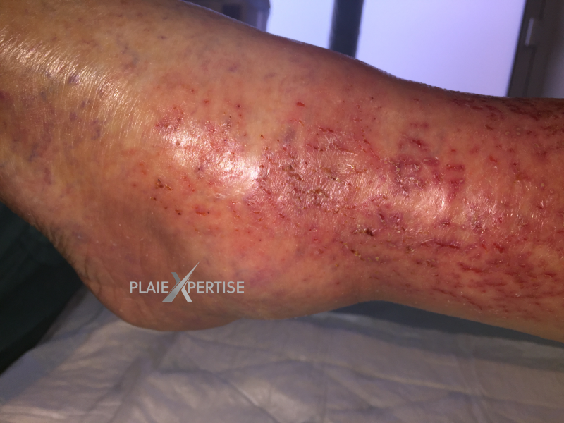 Fichier:Eczéma30.png