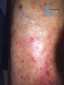 Pustules11.jpg
