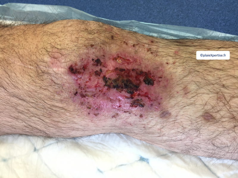 Fichier:Pyoderma gangrenosum7.png