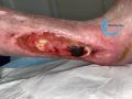 Tendon-Reliquat21.jpg