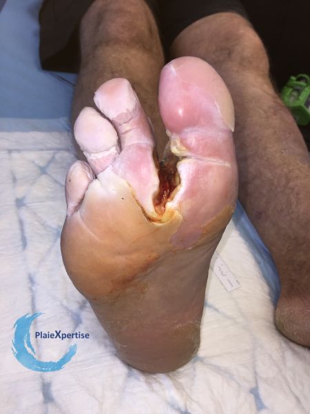 Fichier:Amputation33.jpg