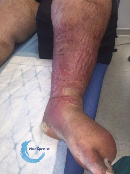 Fichier:Lymphoedème45.jpg