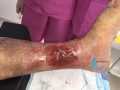 Tissu de granulation inflammatoire26.png