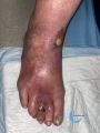 Pied infecté33.jpg