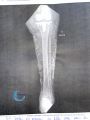 Calcifications48.jpg
