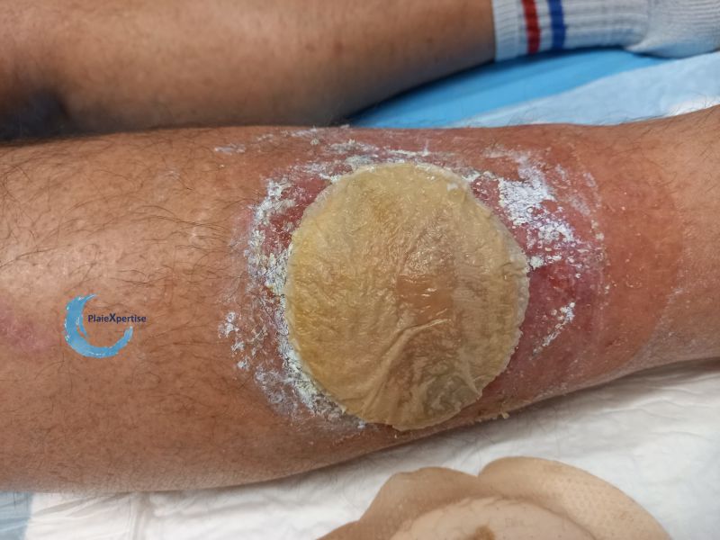 Fichier:Dermite d'irritation193.jpg