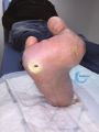 Pied de Charcot52.jpg