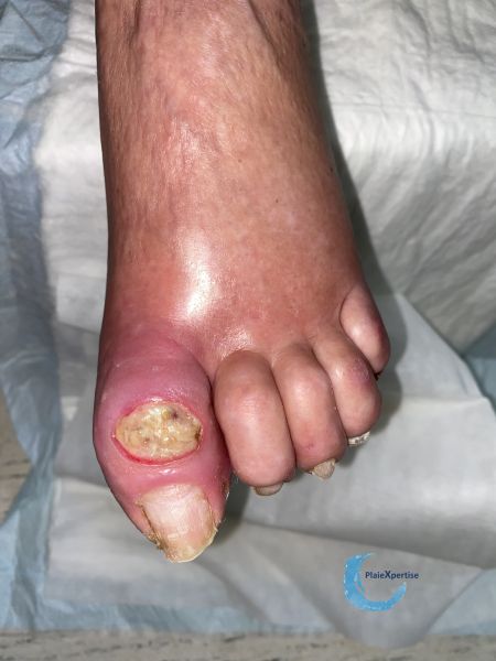 Fichier:Pied infecté24.jpg