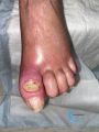 Pied infecté24.jpg