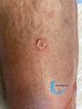 Pustules16.jpg