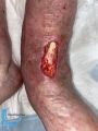 Tendon normal42.jpg