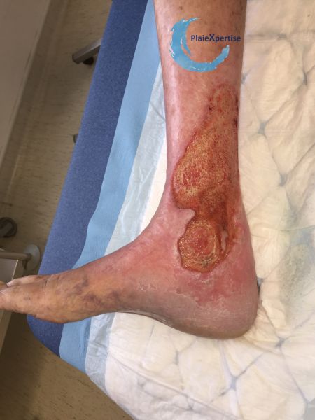 Fichier:Ulcère veineux26.jpg