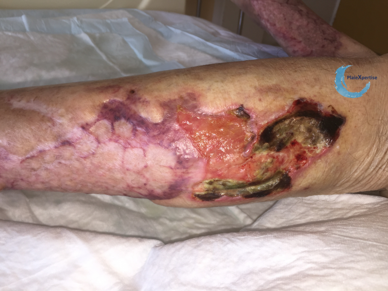 Fichier:Angiodermite typique63.png