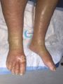 Pied goutteux3.jpg