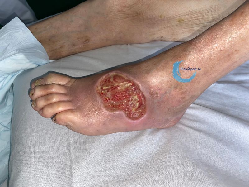 Fichier:Cou de pied101.jpg